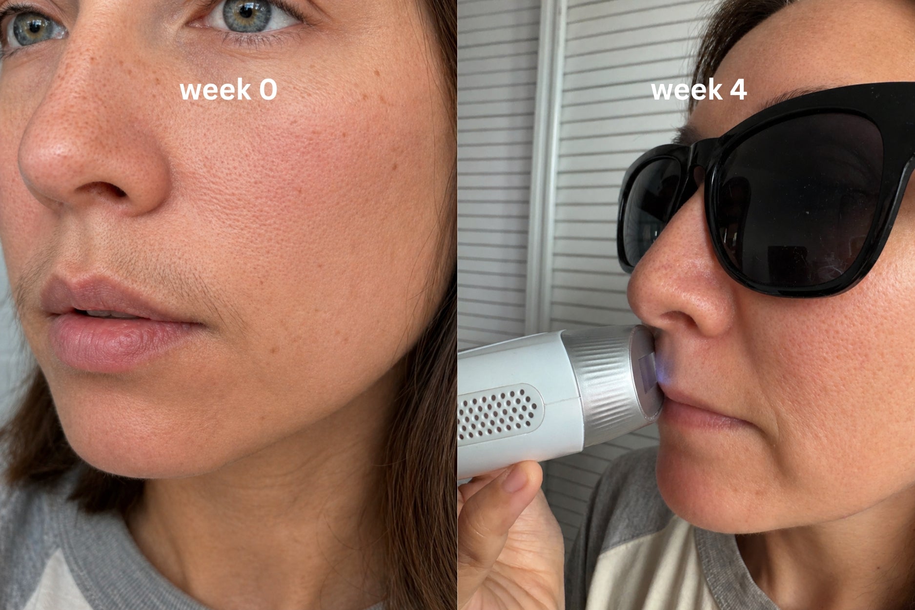 vavame ipl hair removal device review