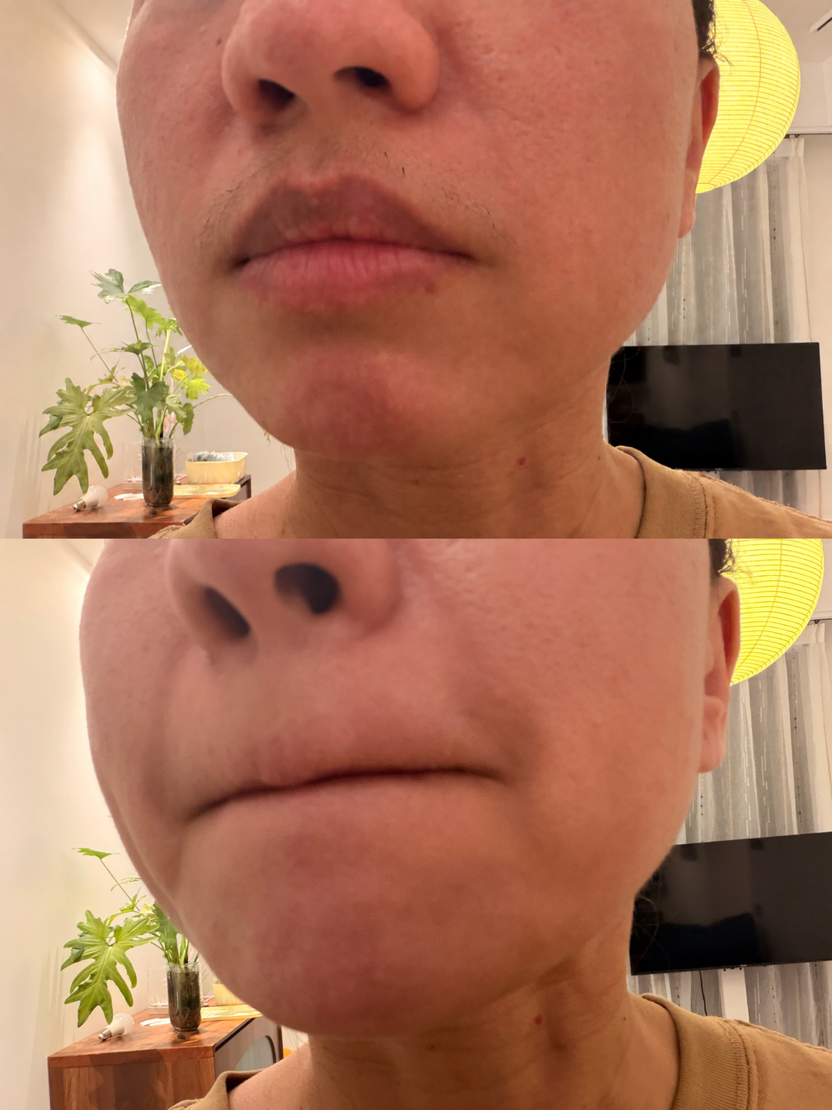 A close-up split-screen comparison of a person's lower face, showing the before-and-after effect of a skincare or cosmetic treatment on the mouth, chin, and jawline.